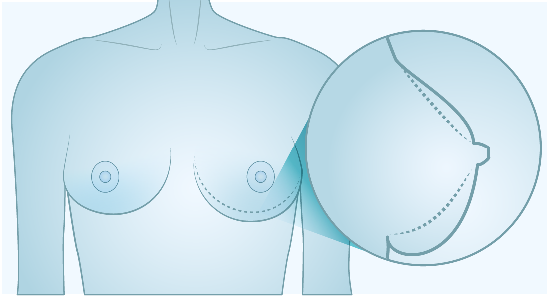 ncrease in size or change in shape of the breast(s)